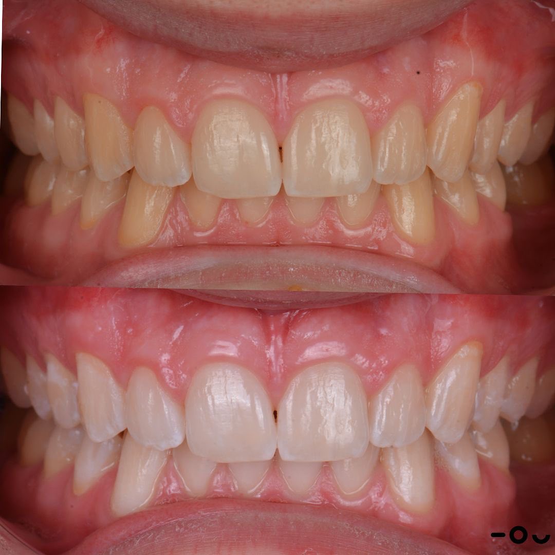 Caso de blanqueamiento dental