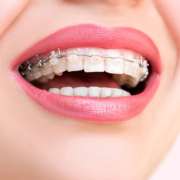 Brackets estéticos