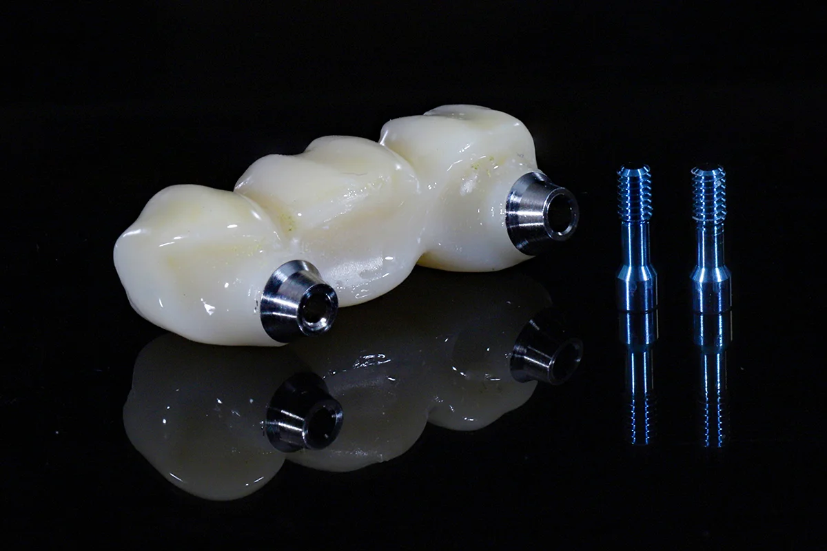 Qué es un implante dental