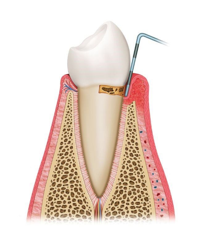 Tratamiento de la gingivitis en Vela Segalà Sant Celoni