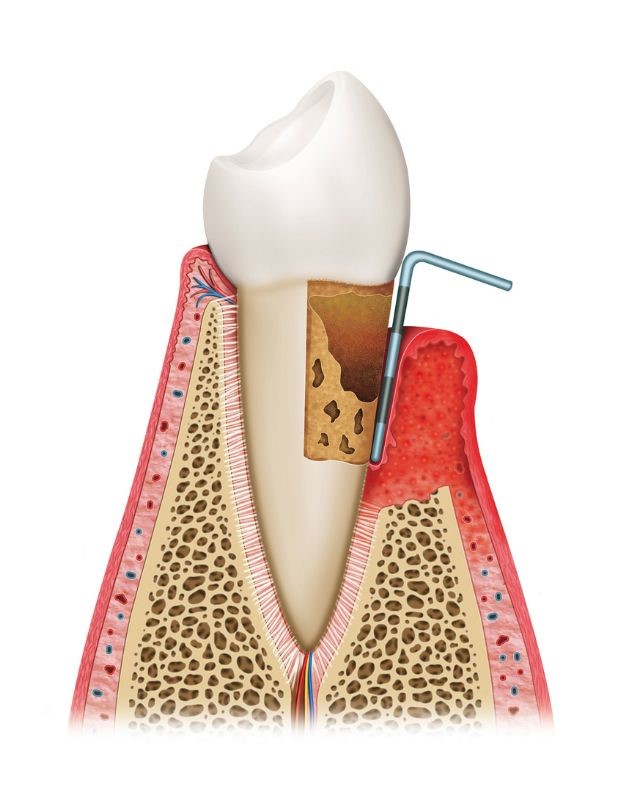 Tratamiento de la periodontitis en Vela Segalà Sant Celoni